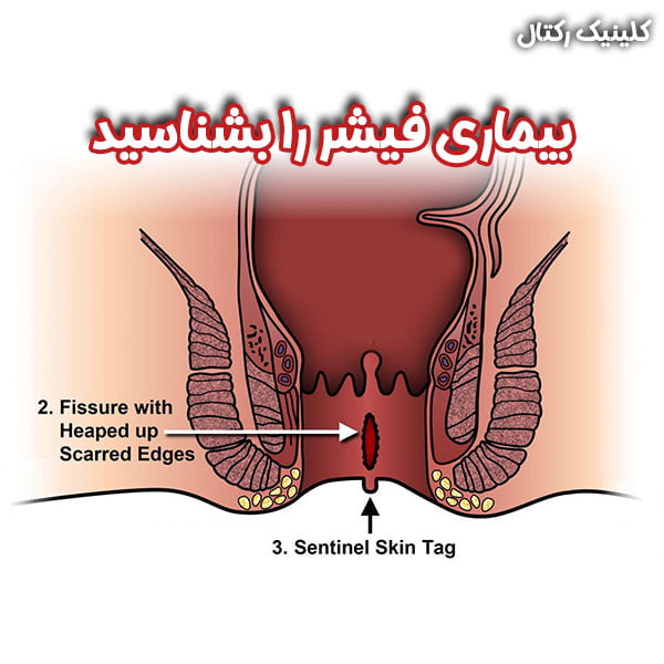 فیشر - کلینیک رکتال