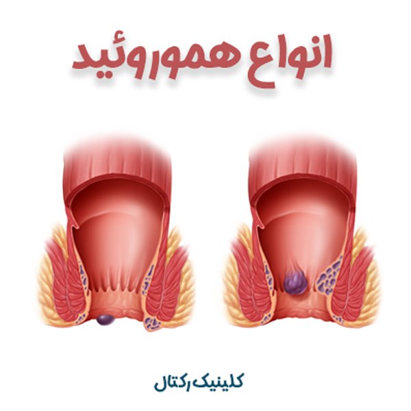 انواع هموروئید - کلینیک رکتال