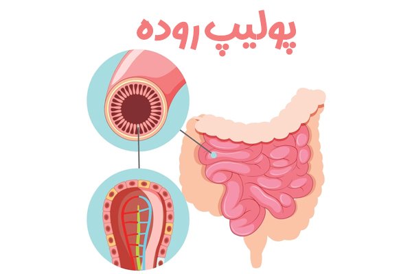 پولیپ روده - کلینیک رکتال