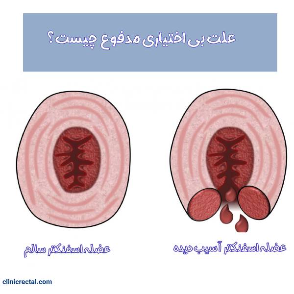 بی اختیاری مدفوع