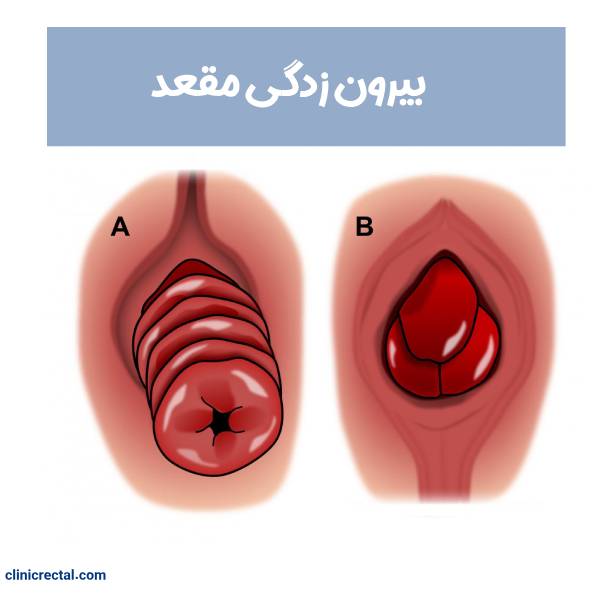 بیرون زدگی مقعد